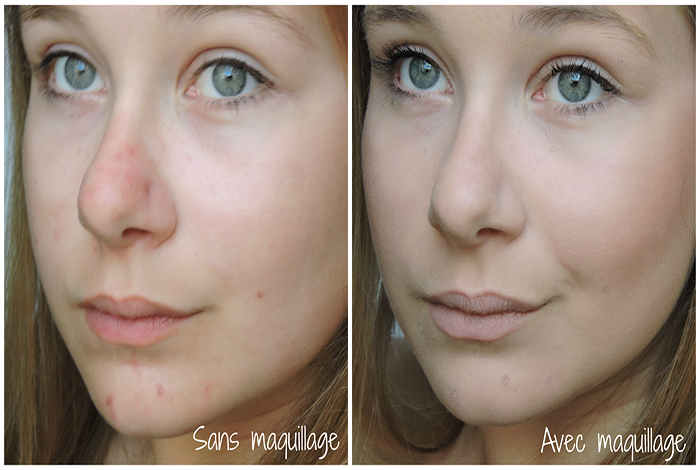 Comment maquiller une peau acnéique ?